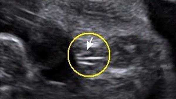 早孕孕囊在左边着床是男孩女孩，B超大夫这样解释快来看